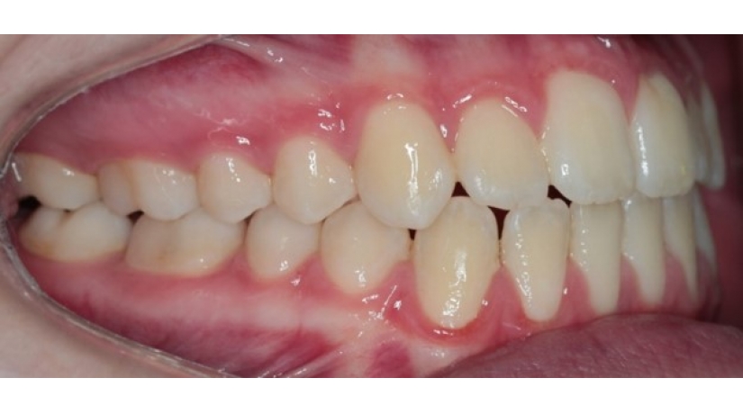 Ortodontia com Capacitação em Laser + Alinhadores