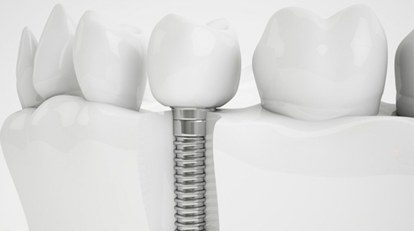 Imersão em Endodontia do Acesso à obturação
