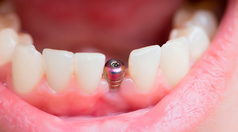 Imersão em Endodontia do Acesso à obturação