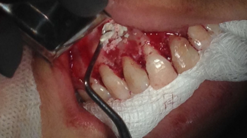 Imersão em Endodontia do Acesso à obturação