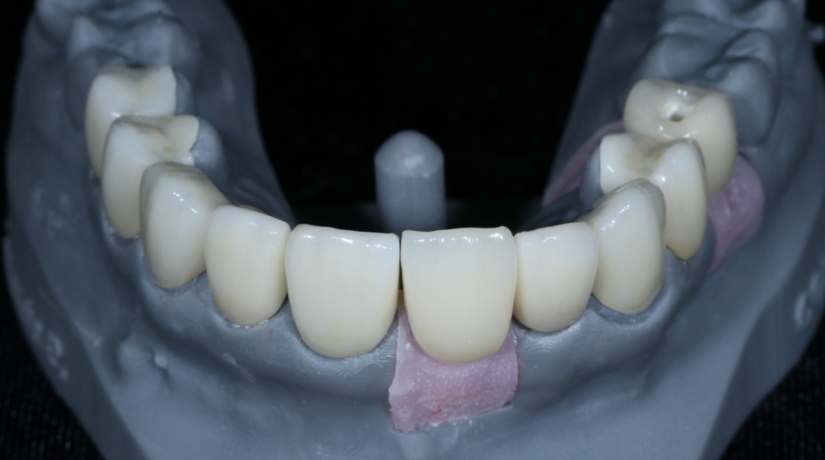 Imersão em Endodontia do Acesso à obturação