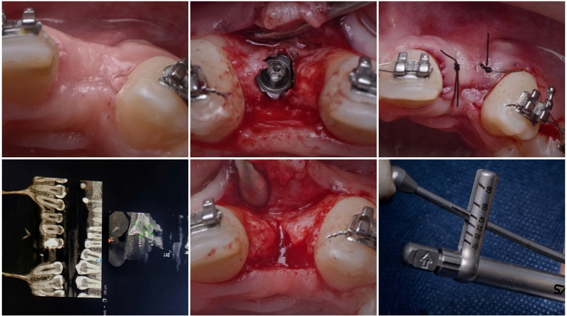 Imersão em Endodontia do Acesso à obturação