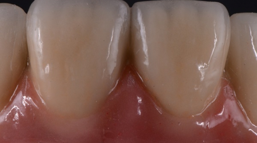 Imersão em Endodontia do Acesso à obturação