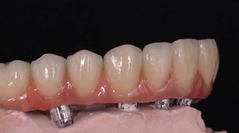 Habilitação em Prótese Sobre Implante com Capacitação em Odontologia Digital