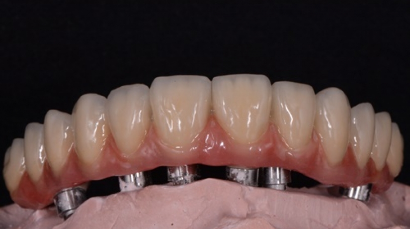 Imersão em Endodontia do Acesso à obturação