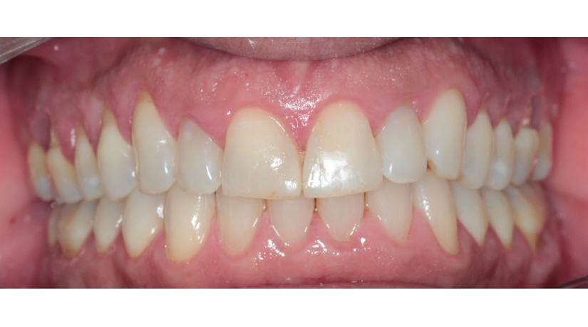 Alinhadores Estéticos - Ortodontia digital & Flex Aligner         