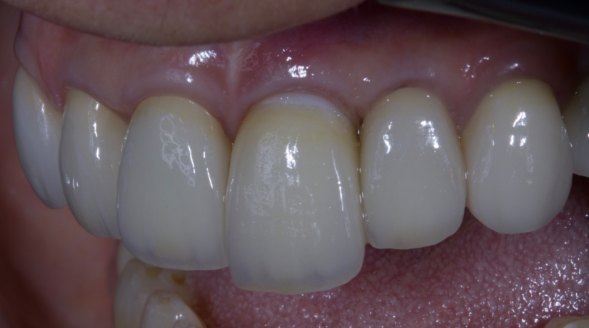 Aperfeiçoamento em Próteses Sobre Implantes com Ênfase em Condicionamento Tecidual Perimplantar e Reabilitação e Áreas Estéticas