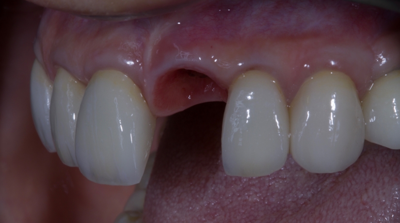 Imersão em Endodontia do Acesso à obturação