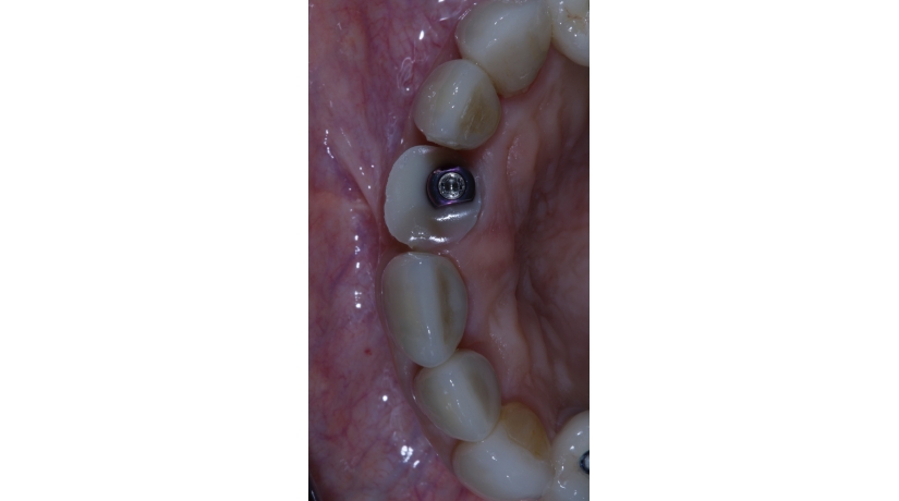 Imersão em Endodontia do Acesso à obturação