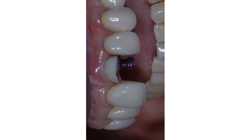 Imersão em Endodontia do Acesso à obturação